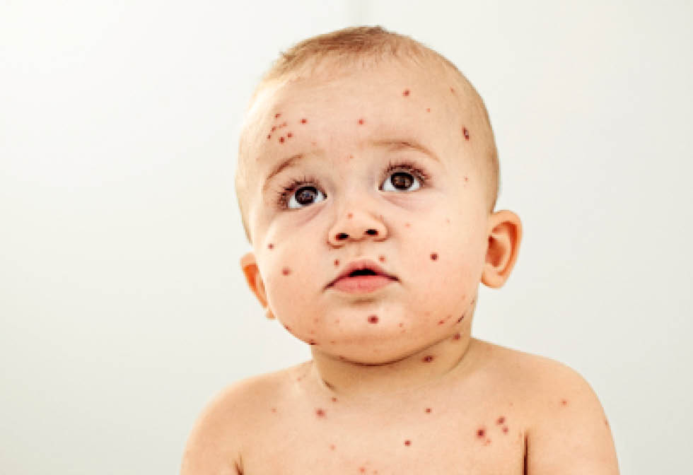 Enfant atteint de varicelle