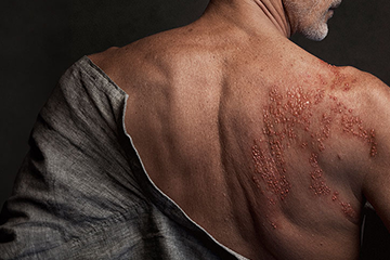 Une personne dont le dos est exposé présente une éruption cutanée avec des ampoules rouges et en relief sur son omoplate droite et le haut de son dos.