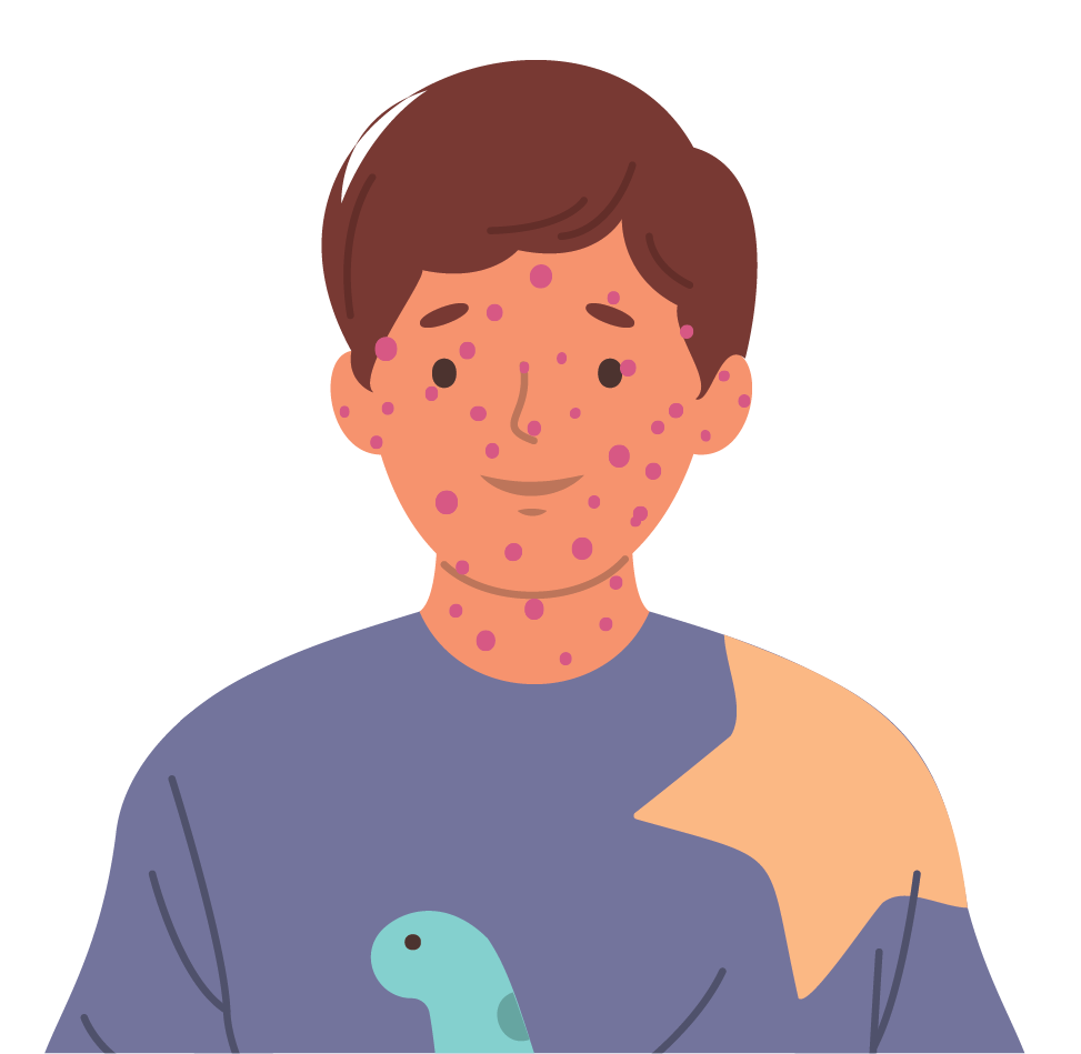 Un jeune garçon atteint d'une éruption de boutons qui le démangent sur le visage, causée par la varicelle. Un jeune garçon atteint d'une éruption de boutons qui le démangent sur le visage, causée par la varicelle.